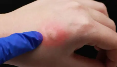 How Severe is the Allergy to Mosquito Bites?